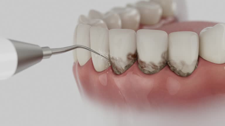 Trusted Dental Crowns And Bridges service in Newport, KY - Dentist Open Now